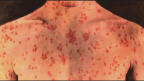 Measles Cases